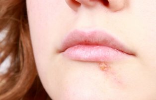 Cum sa scapi de herpes rapid. Cele mai bune solutii