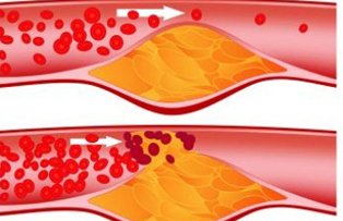 6 intrebari despre colesterol