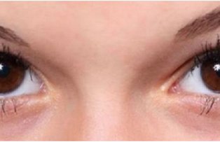 Corpul iti da semnale de alarma! Adevarul din spatele cercurilor negre de sub ochi