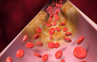 Băutura-minune care reduce colesterolul şi hipertensiunea