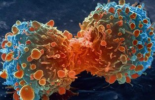 Factori care duc la imbolnavirea de cancer