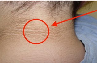 Daca observi un cerc intunecat pe pielea din jurul gatului, adreseaza-te de urgenta unui medic! Afla ce inseamna