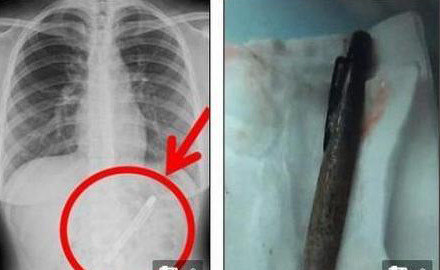 Descoperire socanta! Ce au gasit medicii in stomacul unei femei