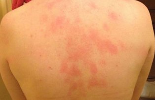 Probleme ale pielii care iti spun ca suferi de o afectiune cu transmitere sexuala