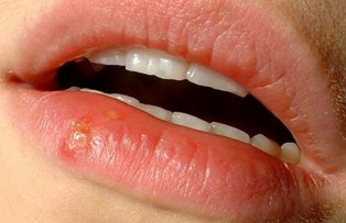 Afla tot ce trebuie sa stii despre herpes si cum il poti trata rapid