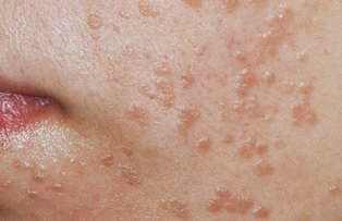 Crema de rostopasca vindeca bolile de piele