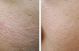 Solutii naturale pentru micsorarea porilor dilatati