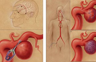 Atentie la anevrismul cerebral