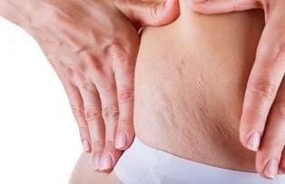 Spune nu interventiilor cu laser si cremelor scumpe – Cum sa scapi de celulita si vergeturi in mod natural in decurs de 10 zile
