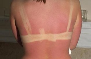 Cele mai bune remedii naturale pentru arsurile solare