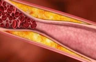 Cum iti dai seama ca ai arterele infundate