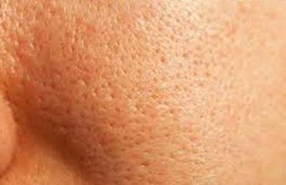 Tratamente naturale pentru porii dilatati