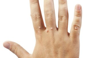 Reteta miraculoasa pentru indepartarea negilor proeminenti