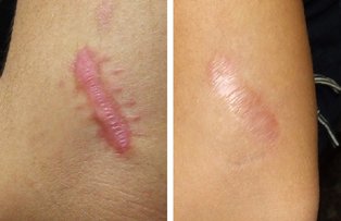 Remedii naturale pentru vindecarea aspectului de cicatrice